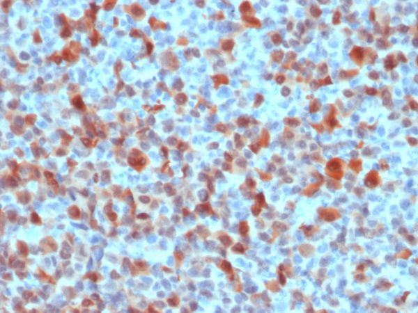 Formalin-fixed, paraffin-embedded human Melanoma stained with S100B Rabbit Polyclonal Antibody.