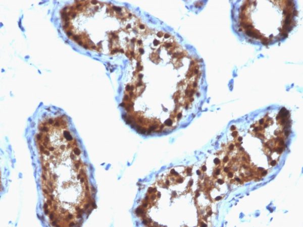 Formalin-fixed, paraffin-embedded human Testicular Carcinoma stained with SUMO-2 Monoclonal Antibody (SPM572).