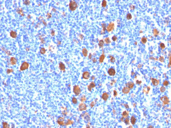 Formalin-fixed, paraffin-embedded human Hodgkin&apos;s Lymphoma stained with Fascin-1 Mouse Monoclonal Antibody (FSCN1/416).