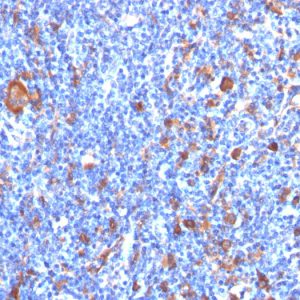 Formalin-fixed, paraffin-embedded human Hodgkin&apos;s Lymphoma stained with Fascin-1 Mouse Monoclonal Antibody (FSCN1/417)