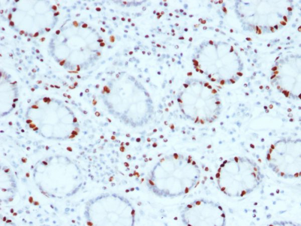 Formalin-fixed, paraffin-embedded human Colon Carcinoma stained with SOX4 Mouse Monoclonal Antibody (SOX4/2540).