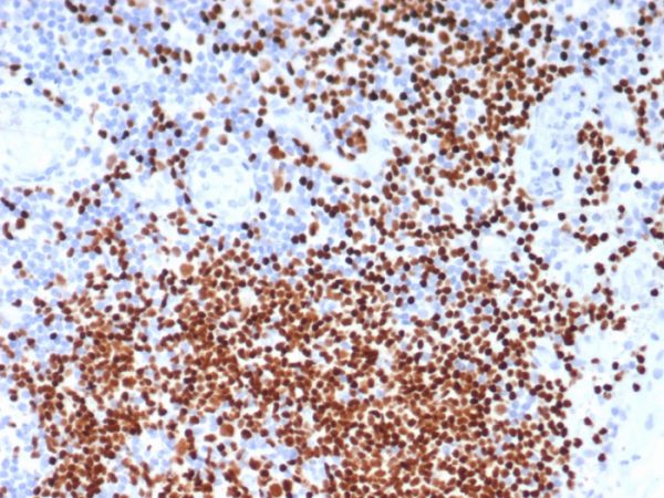 Formalin-fixed, paraffin-embedded human lymph node stained with SOX11 Mouse Monoclonal Antibody (SOX11/7236). HIER: Tris/EDTA, pH9.0, 45min. 2°C: HRP-polymer, 30min. DAB, 5min.