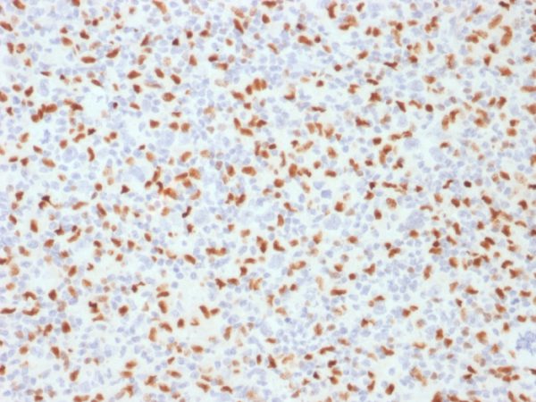 Formalin-fixed, paraffin-embedded human Hodgkin&apos;s Lymphoma stained with PU.1-Monospecific Mouse Monoclonal Antibody (PU1/2146).