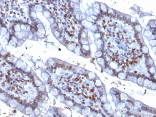 Formalin-fixed, paraffin-embedded human Colon Carcinoma stained with PU.1-Monospecific Mouse Monoclonal Antibody (PU1/2146).