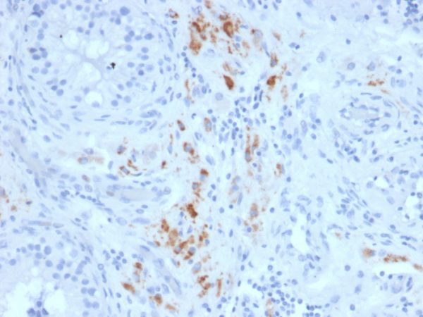 Formalin-fixed, paraffin-embedded human Testicular Carcinoma stained with StAR Mouse Monoclonal Antibody (STAR/2140).