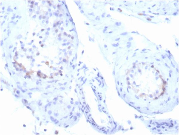 Formalin-fixed, paraffin-embedded human testicular carcinoma stained with StARRecombinant Rabbit Monoclonal Antibody (STAR/3915R). HIER: Tris/EDTA, pH9.0, 45min. 2°C: HRP-polymer, 30min. DAB, 5min.