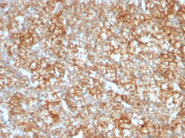 Formalin-fixed, paraffin-embedded human Renal Cell Carcinoma stained with CD147 Mouse Monoclonal Antibody (BSG/963).