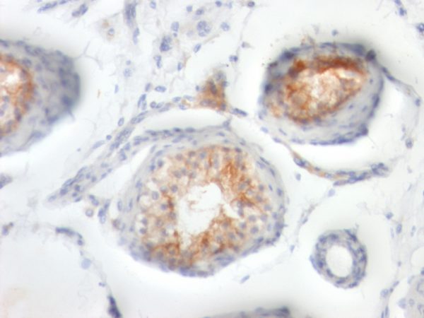 Formalin-fixed, paraffin-embedded human Testicular Carcinoma stained with CD147 Mouse Monoclonal Antibody (BSG/963).
