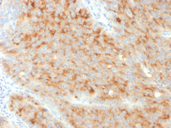 Formalin-fixed, paraffin-embedded human Pancreatic Carcinoma stained with Synaptophysin-Monospecific Mouse Monoclonal Antibody (SYP/3551).