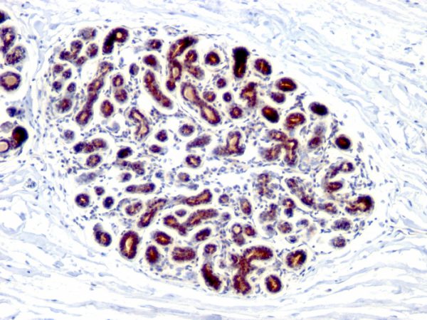 Formalin-fixed, paraffin-embedded human Breast Carcinoma stained with pS2 Mouse Monoclonal Antibody (GE2).