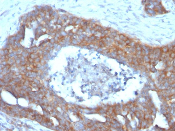 Formalin-fixed, paraffin-embedded human Ovarian Carcinoma stained with pS2 Mouse Monoclonal Antibody (GE2).