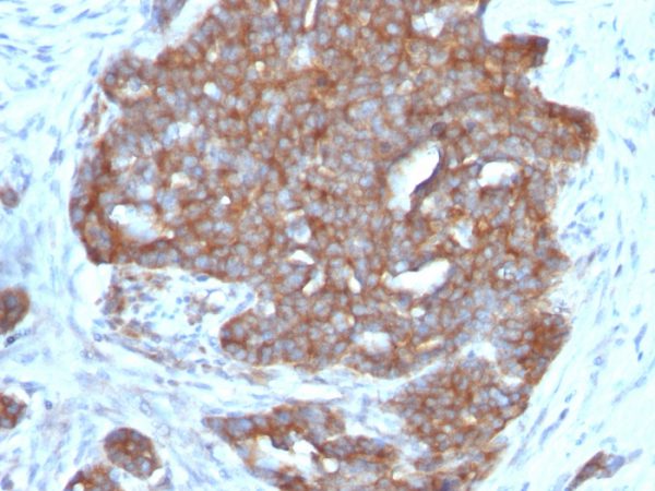 Formalin-fixed, paraffin-embedded human Ovarian Carcinoma stained with pS2 Monoclonal Antibody (SPM313).