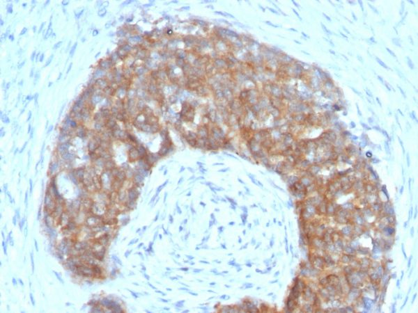 Formalin-fixed, paraffin-embedded human Ovarian Carcinoma stained with pS2 Mouse Monoclonal Antibody (SPM313).