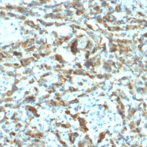 Formalin-fixed, paraffin-embedded human Breast Carcinoma stained with TFF1/pS2 Mouse Monoclonal Antibody (TFF1/2133).