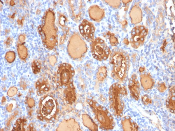 Formalin-fixed, paraffin-embedded human Thyroid stained with Thyroglobulin Mouse Recombinant Monoclonal Antibody (r2H11).