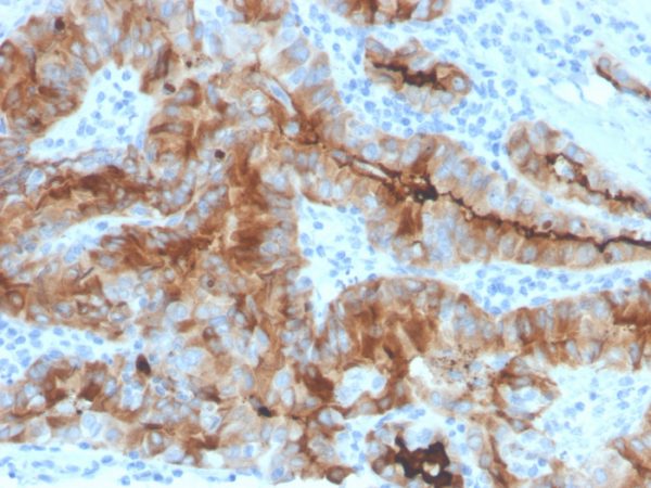 Formalin-fixed, paraffin-embedded human thyroid carcinoma stained with Thyroglobulin Mouse Recombinant Monoclonal Antibody (rTGB/4744).