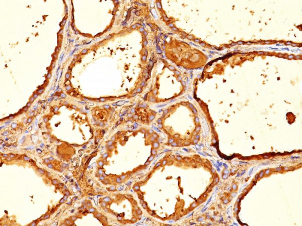 Formalin-fixed, paraffin-embedded human Thyroid stained with  Thyroglobulin Mouse Monoclonal Antibody (6E1).