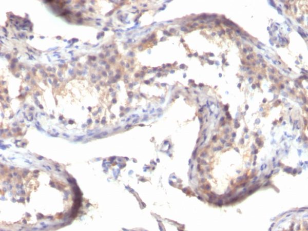 Formalin-fixed, paraffin-embedded human Testicular Carcinoma stained with TGF alpha Mouse Monoclonal Antibody (MF9)