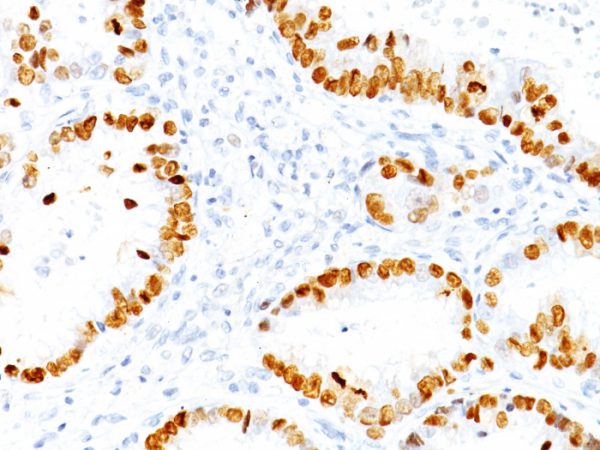 TTF-1 / NKX2.1 (Thyroid & Lung Epithelial Marker) Antibody