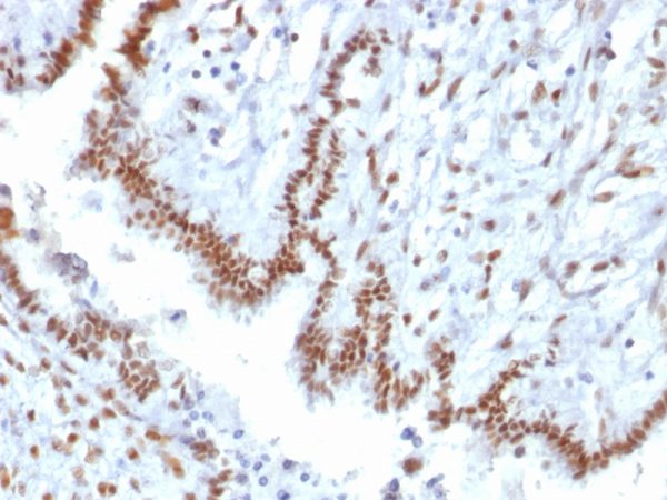 Formalin-fixed, paraffin-embedded human Endometrial Carcinoma stained with TLE1 Mouse Monoclonal Antibody (TLE1/2085).