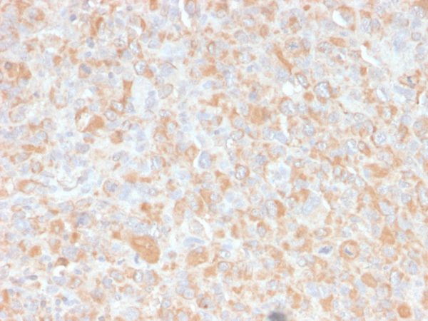 Formalin-fixed, paraffin-embedded human Histiocytoma stained with TNF alpha Mouse Monoclonal Antibody (4C6-H8).