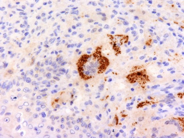 Formalin-fixed, paraffin-embedded human Erdheim-Chester disease (also known as polyostotic sclerosing histiocytosis) stained with TNF alpha Mouse Monoclonal Antibody (P/T2).