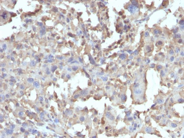 Formalin-fixed, paraffin-embedded human Histiocytoma stained with TNF alpha Rabbit Recombinant Monoclonal Antibody (TNF/1500R).