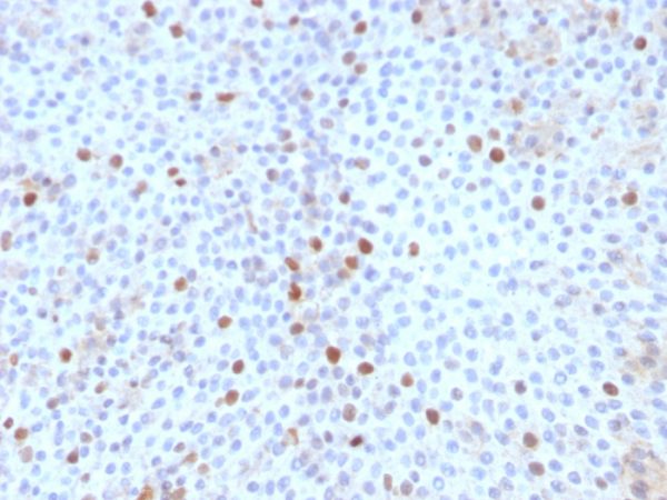 Formalin-fixed, paraffin-embedded human Bladder Carcinoma stained with Topoisomerase II alpha Monoclonal Antibody (TOP2A/1361).