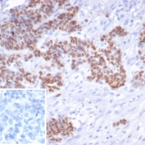 Formalin-fixed, paraffin-embedded human serous ovarian carcinoma stained with p53 Recombinant Mouse Monoclonal Antibody (rTP53/6940). Inset: PBS instead of primary antibody; secondary only negative control.