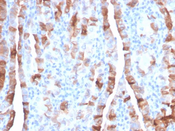 Formalin-fixed, paraffin-embedded human thyroid carcinoma stained with Thyroid Peroxidase Mouse Monoclonal Antibody (TPO/3701).