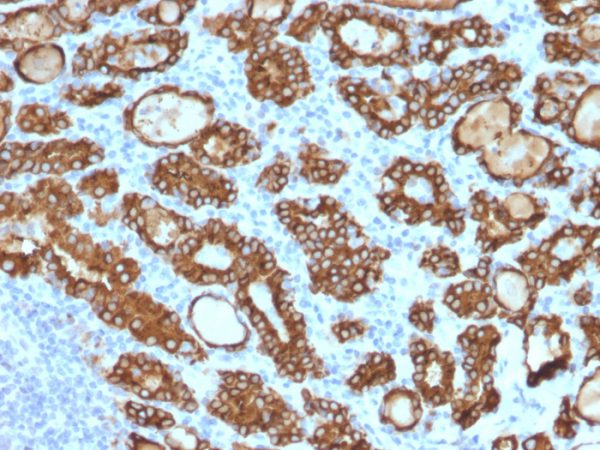 Formalin-fixed, paraffin-embedded human Thyroid Carcinoma stained with Thyroid Peroxidase Mouse Monoclonal Antibody (TPO/1922).