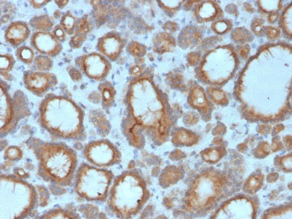 Formalin-fixed, paraffin-embedded human Thyroid Carcinoma stained with Thyroid Peroxidase Mouse Monoclonal Antibody (TPO/3695).