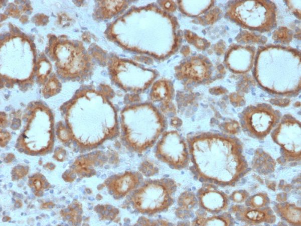 Formalin-fixed, paraffin-embedded human Thyroid Carcinoma stained with Thyroid Peroxidase Mouse Monoclonal Antibody (TPO/3695).