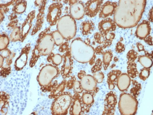 Formalin-fixed, paraffin-embedded human thyroid carcinoma stained with TPO Recombinant Rabbit Monoclonal Antibody (TPO/3813R).