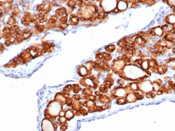 Formalin-fixed, paraffin-embedded human thyroid carcinoma stained with Thyroid Peroxidase Recombinant Rabbit Monoclonal Antibody (TPO/6417R).