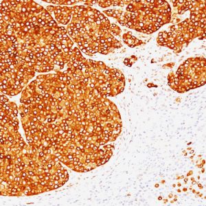 Formalin-fixed, paraffin-embedded human melanoma stained with Tyrosinase Mouse Monoclonal Antibody (SPM360).