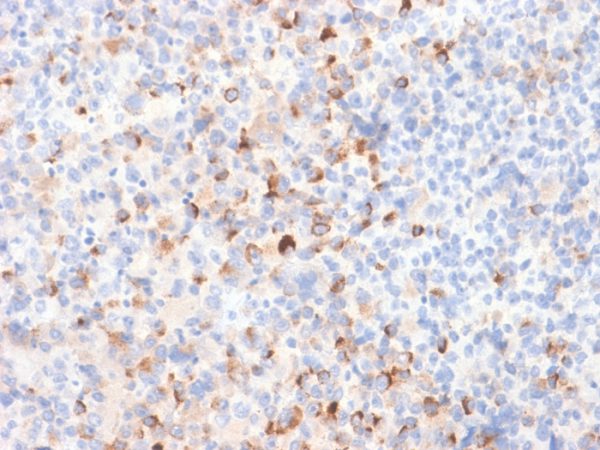 Formalin-fixed, paraffin-embedded Melanoma stained with Tyrosinase Rabbit Recombinant Monoclonal Antibody (TYR/2024R).