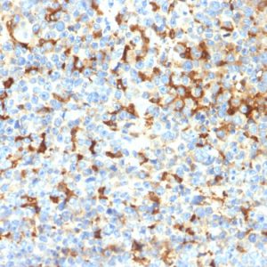 Formalin-fixed, paraffin-embedded human Melanoma stained with TYRP1 Recombinant Rabbit Monoclonal (TYRP1/2340R); DAB Chromogen.