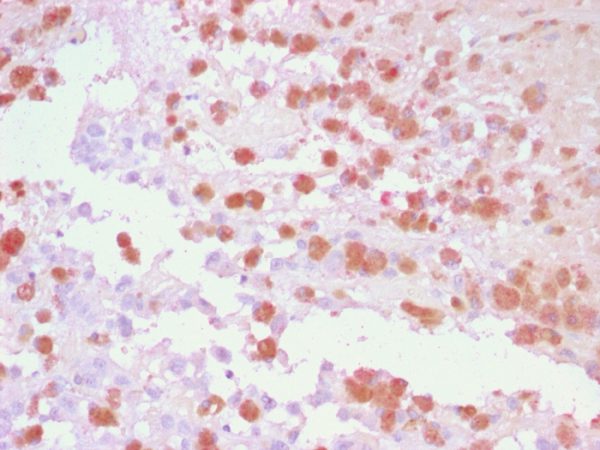 Formalin-fixed, paraffin-embedded human Melanoma stained with TYRP1 Rabbit Polyclonal Antibody using AEC Chromogen (red).