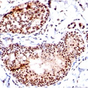Formalin-fixed, paraffin-embedded human Breast Carcinoma stained with SUMO-1 Mouse Monoclonal Antibody (SM1/495)