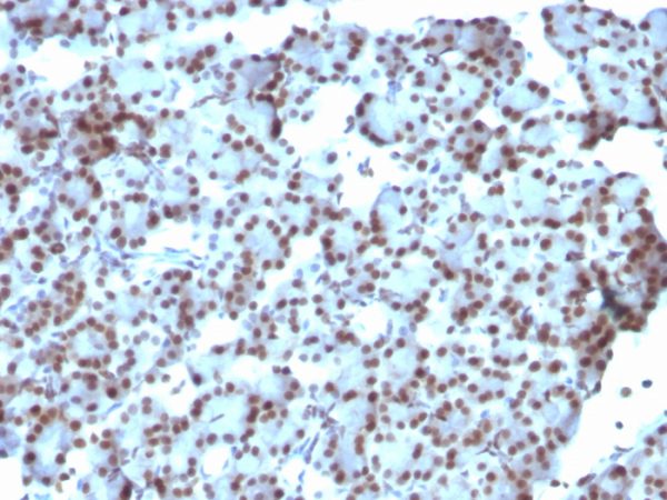 Formalin-fixed, paraffin-embedded human Ovarian Carcinoma stained with SUMO-1 Monoclonal Antibody (SUMO1/1188)