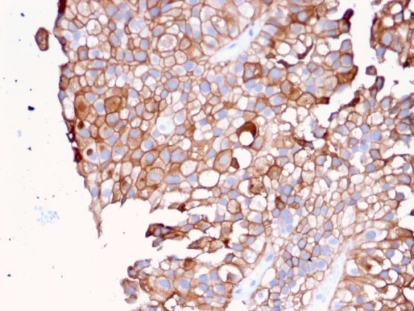 Formalin-fixed, paraffin-embedded human Urothelial Carcinoma stained with Uroplakin 1B Mouse Monoclonal Antibody (UPK1B/3081).