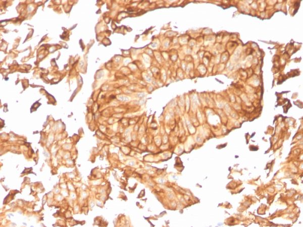 Formalin-fixed, paraffin-embedded human Urothelial Carcinoma stained with Uroplakin 1B Mouse Monoclonal Antibody (UPK1B/3081).