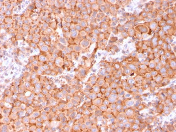 Formalin-fixed, paraffin-embedded human Urothelial Carcinoma stained with Uroplakin 1B Mouse Monoclonal Antibody (UPK1B/3081).