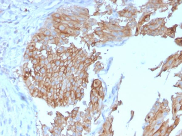 Formalin-fixed, paraffin-embedded human Urothelial Carcinoma stained with Uroplakin 1B Mouse Monoclonal Antibody (UPK1B/3102).