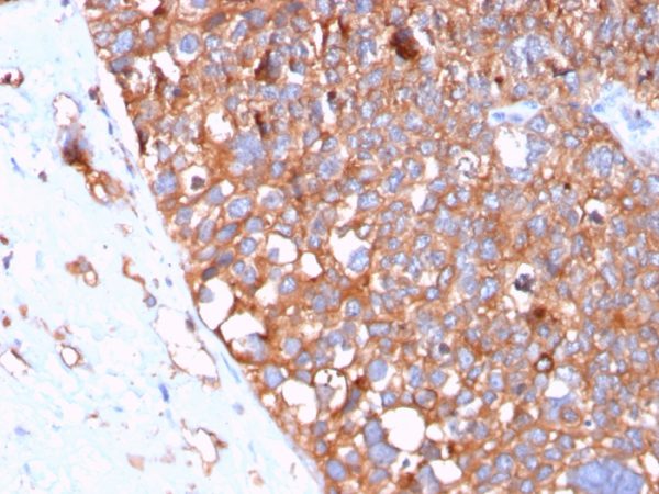 Formalin-fixed, paraffin-embedded human Urothelial Carcinoma stained with Uroplakin 1B Mouse Monoclonal Antibody (UPK1B/3102).