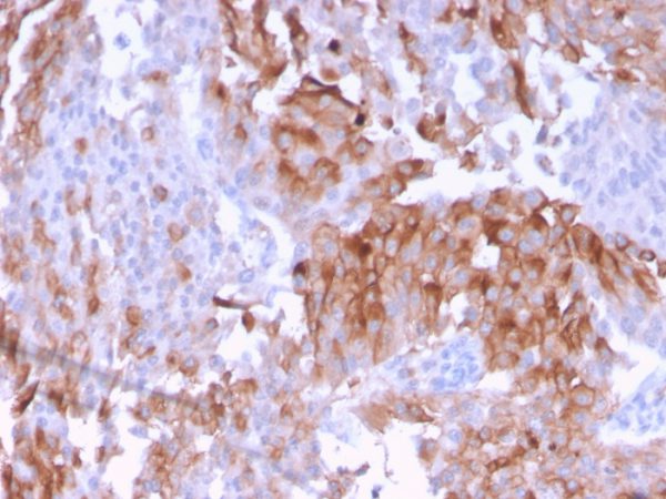 Formalin-fixed, paraffin-embedded human Urothelial Carcinoma stained with Uroplakin 1B Mouse Monoclonal Antibody (UPK1B/3102).