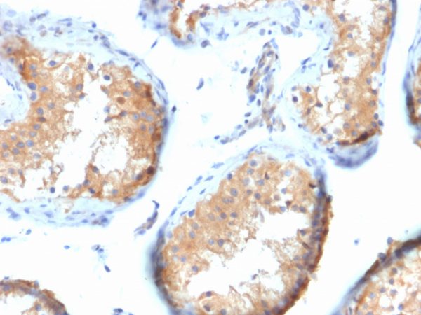Formalin-fixed, paraffin-embedded human Testicular Carcinoma stained with Vinculin Mouse Monoclonal Antibody (VCL/2573).