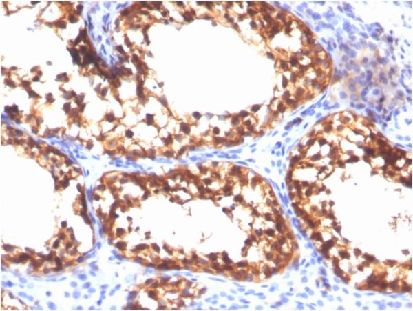 Formalin-fixed, paraffin-embedded human Testicular Carcinoma stained with VCL-Monospecific Mouse Monoclonal Antibody (VCL/3617).
