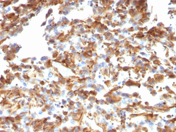 Formalin-fixed, paraffin-embedded human Melanoma stained with Vimentin Mouse Monoclonal Antibody (VM1170).